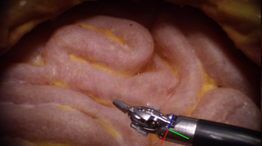 A surgical tool in use